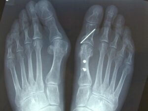 An X-ray image of feet, with a plate, wire or screw